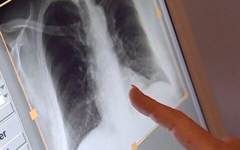 蒙特利尔等魁省多地的结核病病例急剧增加